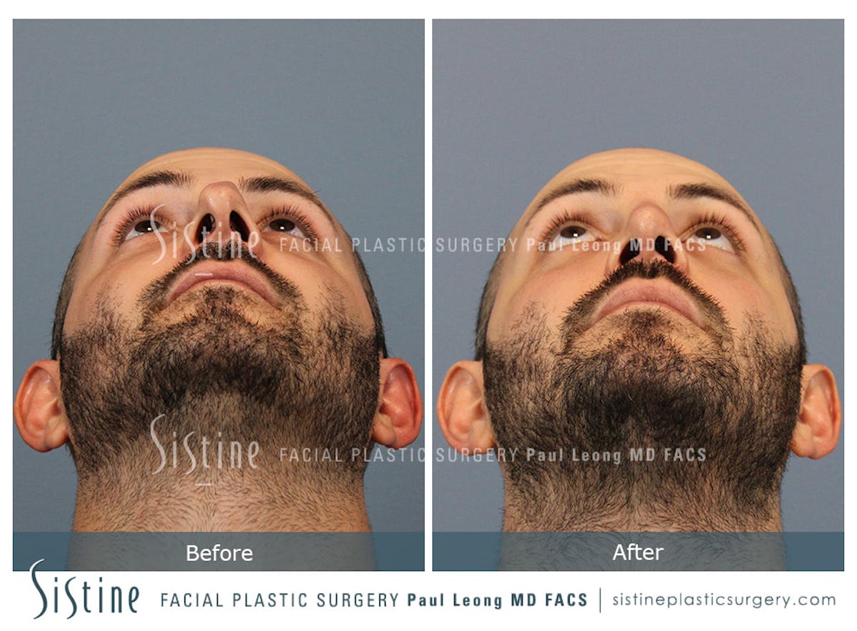 Rhinoplasty Before & After Gallery - Patient 101021 - Image 10