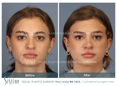 Rhinoplasty Before & After Gallery - Patient 182121 - Image 1