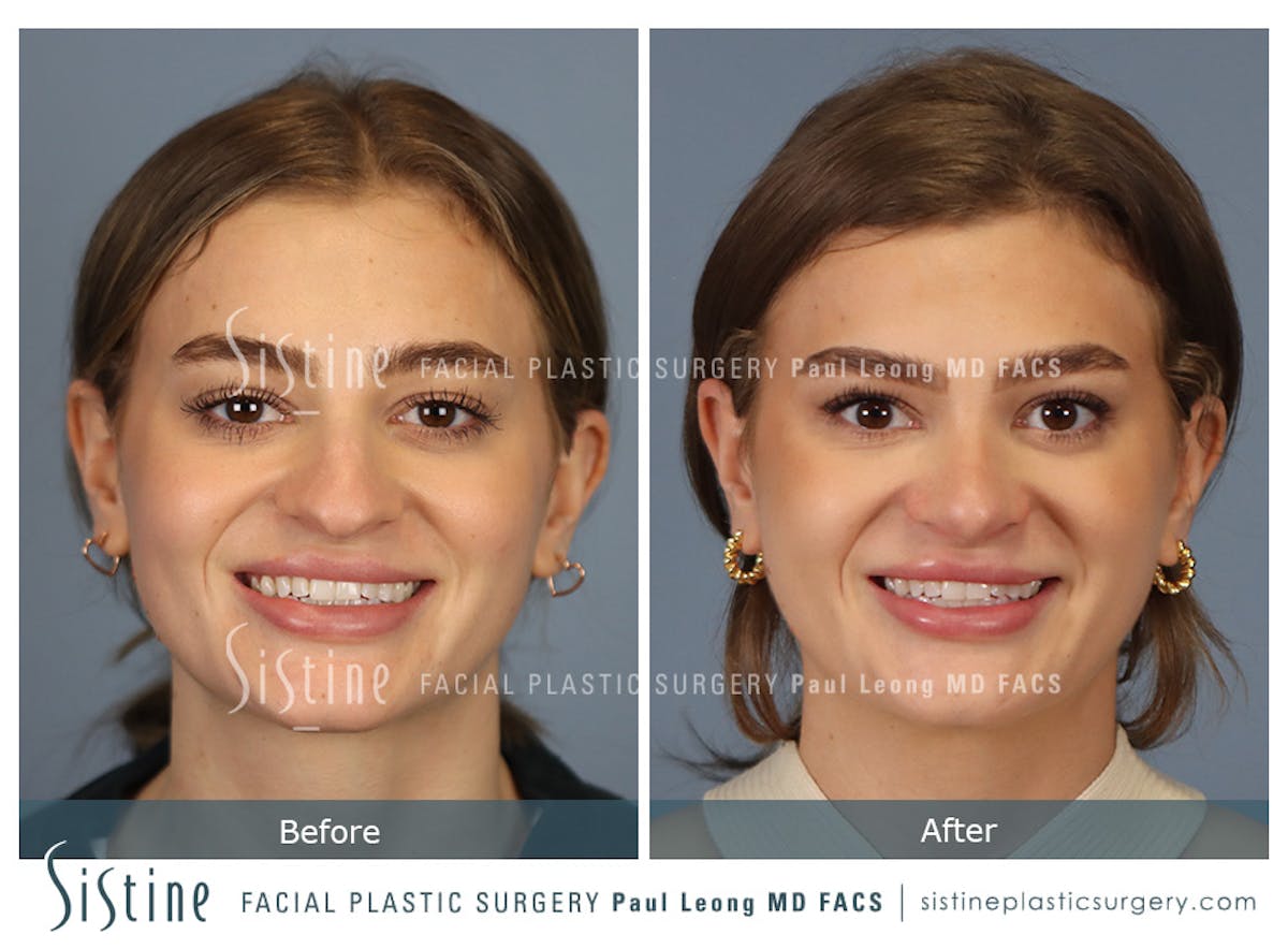 Rhinoplasty Before & After Gallery - Patient 182121 - Image 2