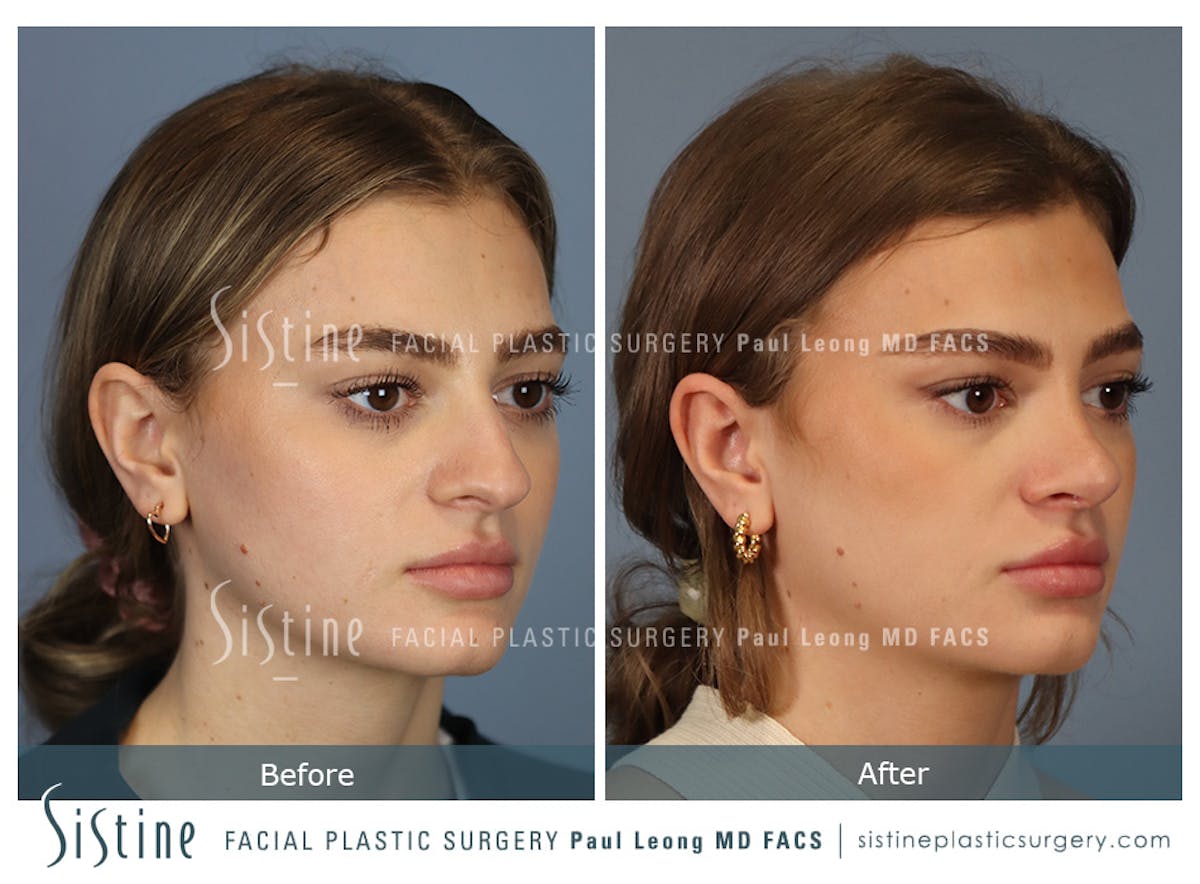 Rhinoplasty Before & After Gallery - Patient 182121 - Image 3
