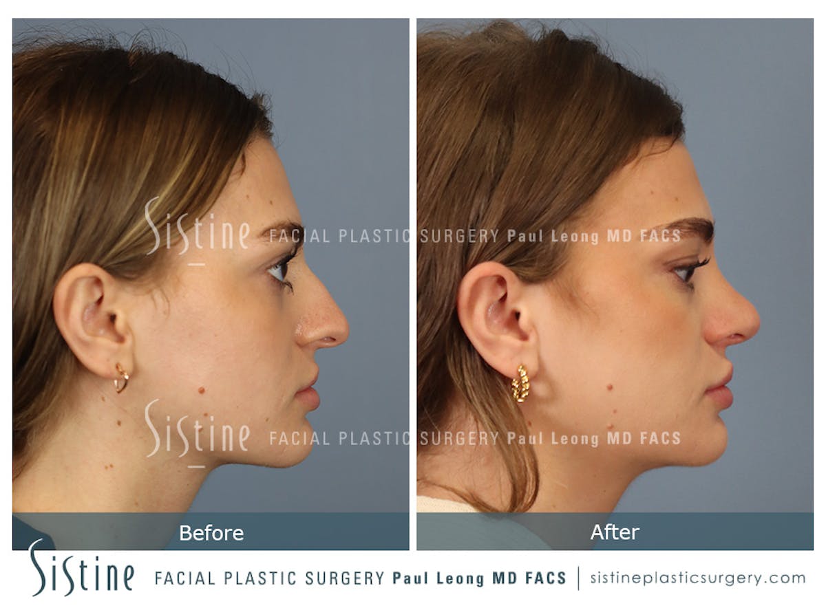 Rhinoplasty Before & After Gallery - Patient 182121 - Image 4