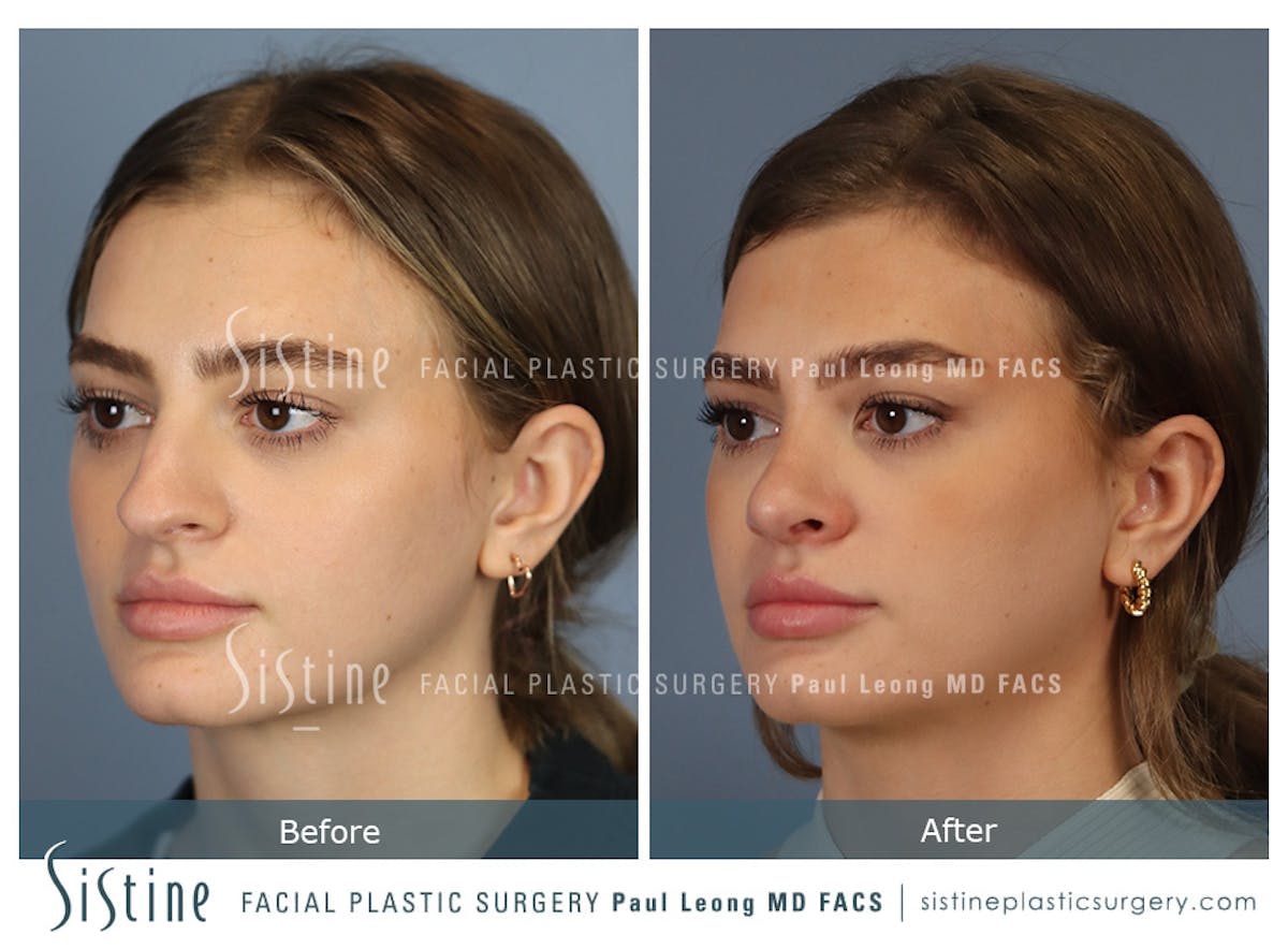 Rhinoplasty Before & After Gallery - Patient 182121 - Image 6