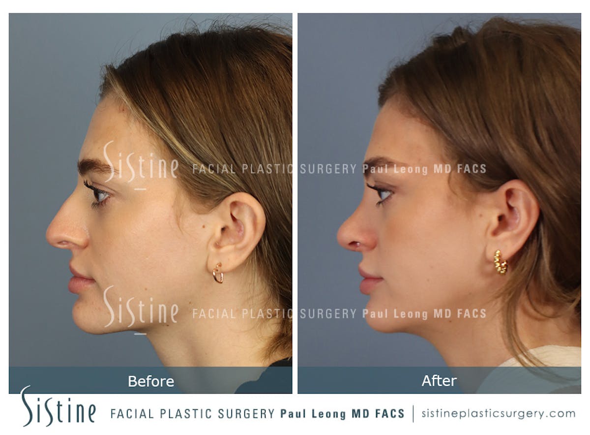 Rhinoplasty Before & After Gallery - Patient 182121 - Image 7