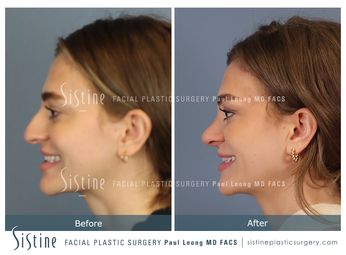 Rhinoplasty Before & After Gallery - Patient 182121 - Image 8