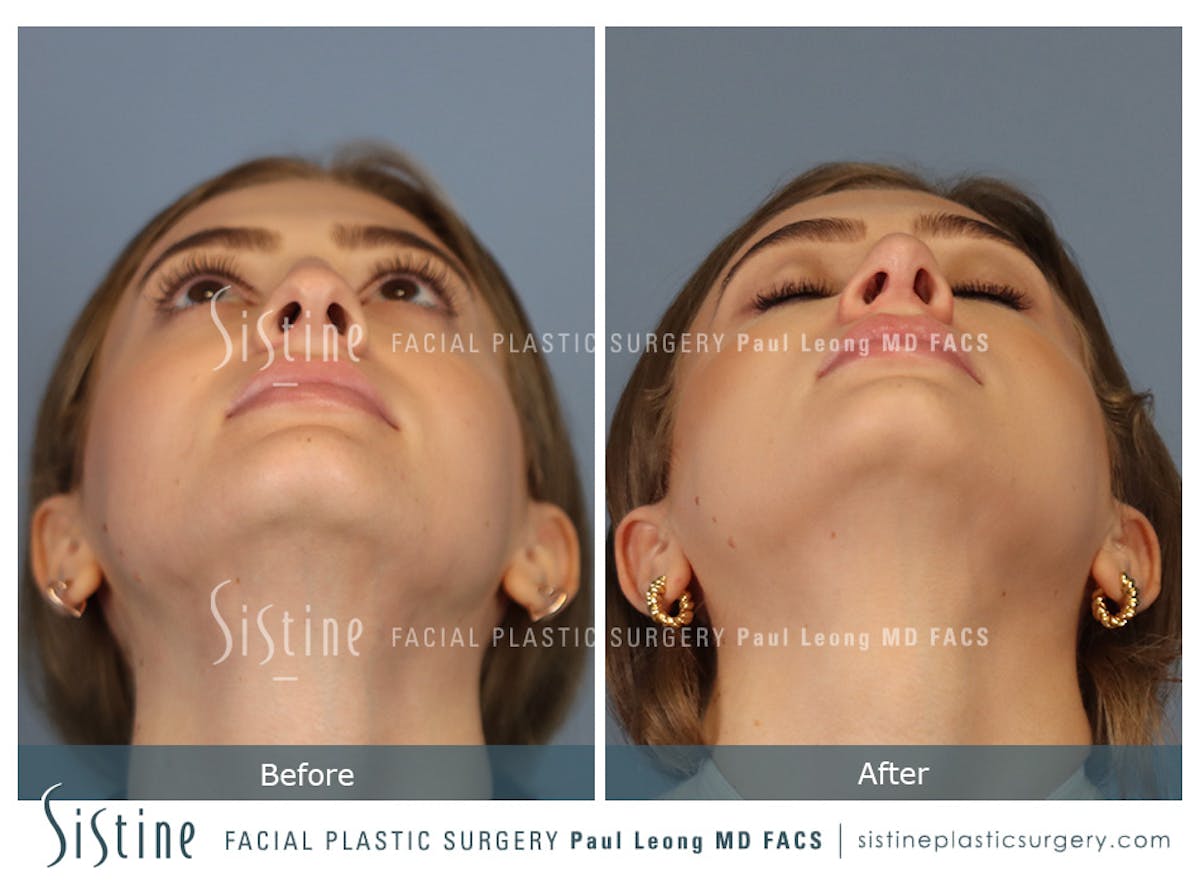 Rhinoplasty Before & After Gallery - Patient 182121 - Image 9