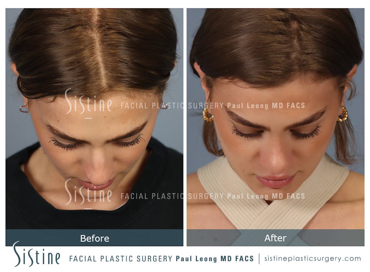 Rhinoplasty Before & After Gallery - Patient 182121 - Image 10