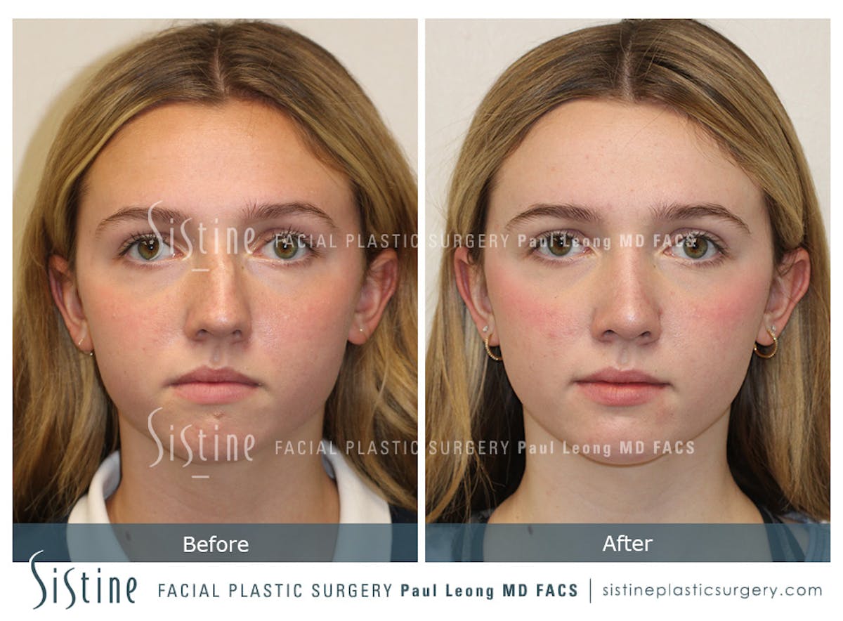 Rhinoplasty Before & After Gallery - Patient 190914 - Image 1