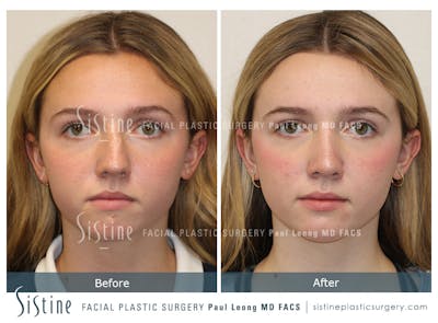 Rhinoplasty Before & After Gallery - Patient 190914 - Image 1