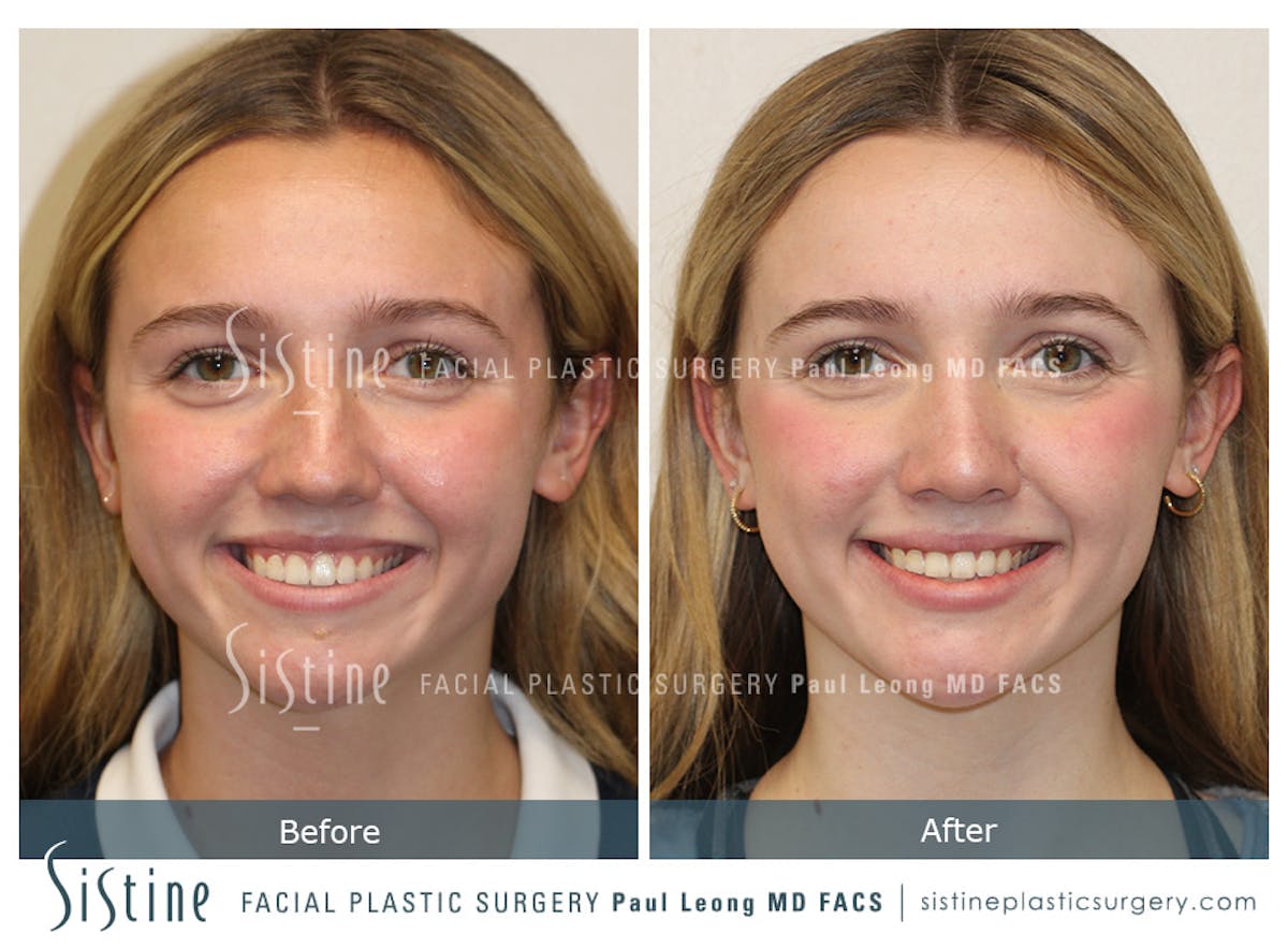 Rhinoplasty Before & After Gallery - Patient 190914 - Image 2