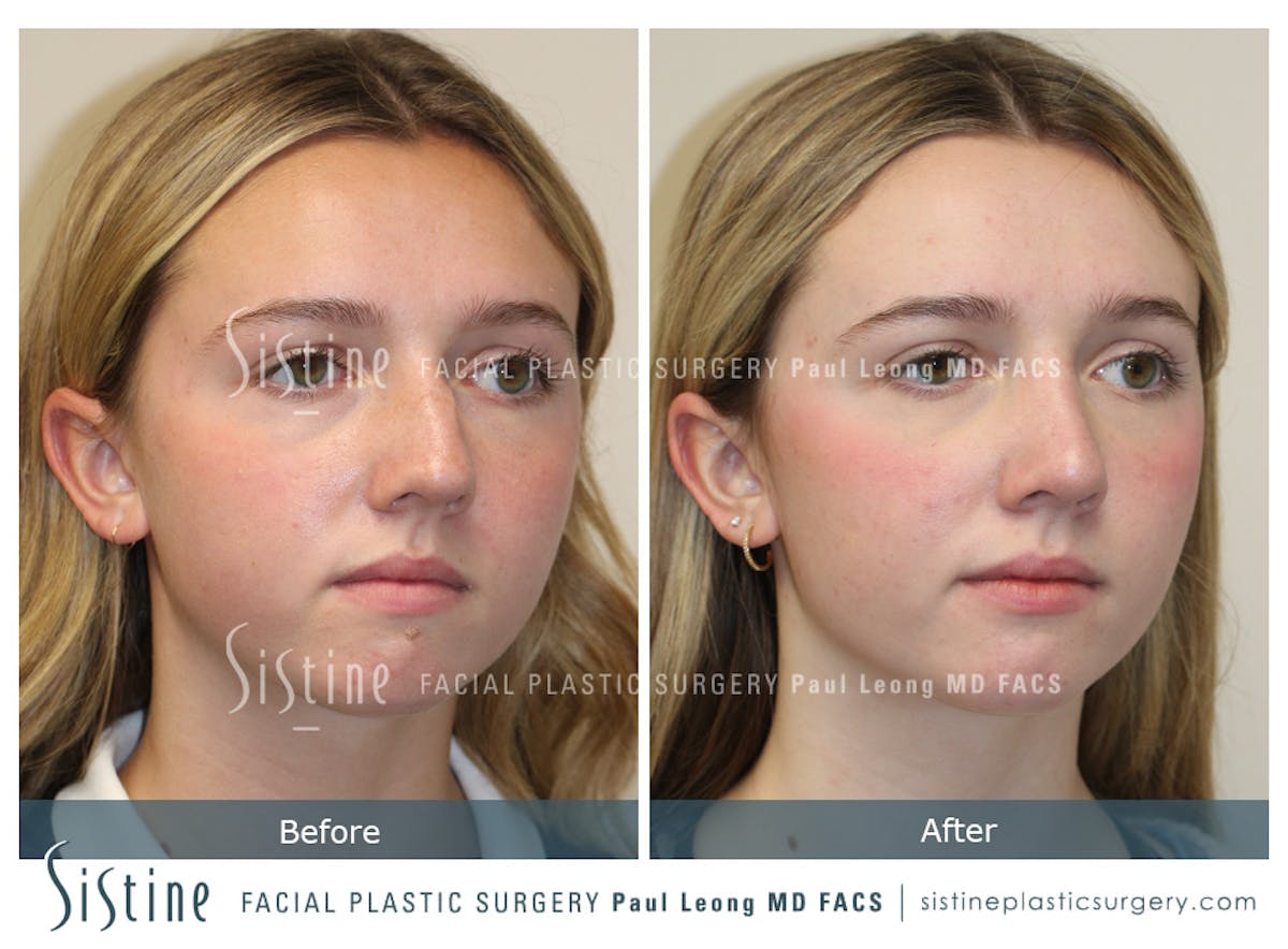 Rhinoplasty Before & After Gallery - Patient 190914 - Image 4