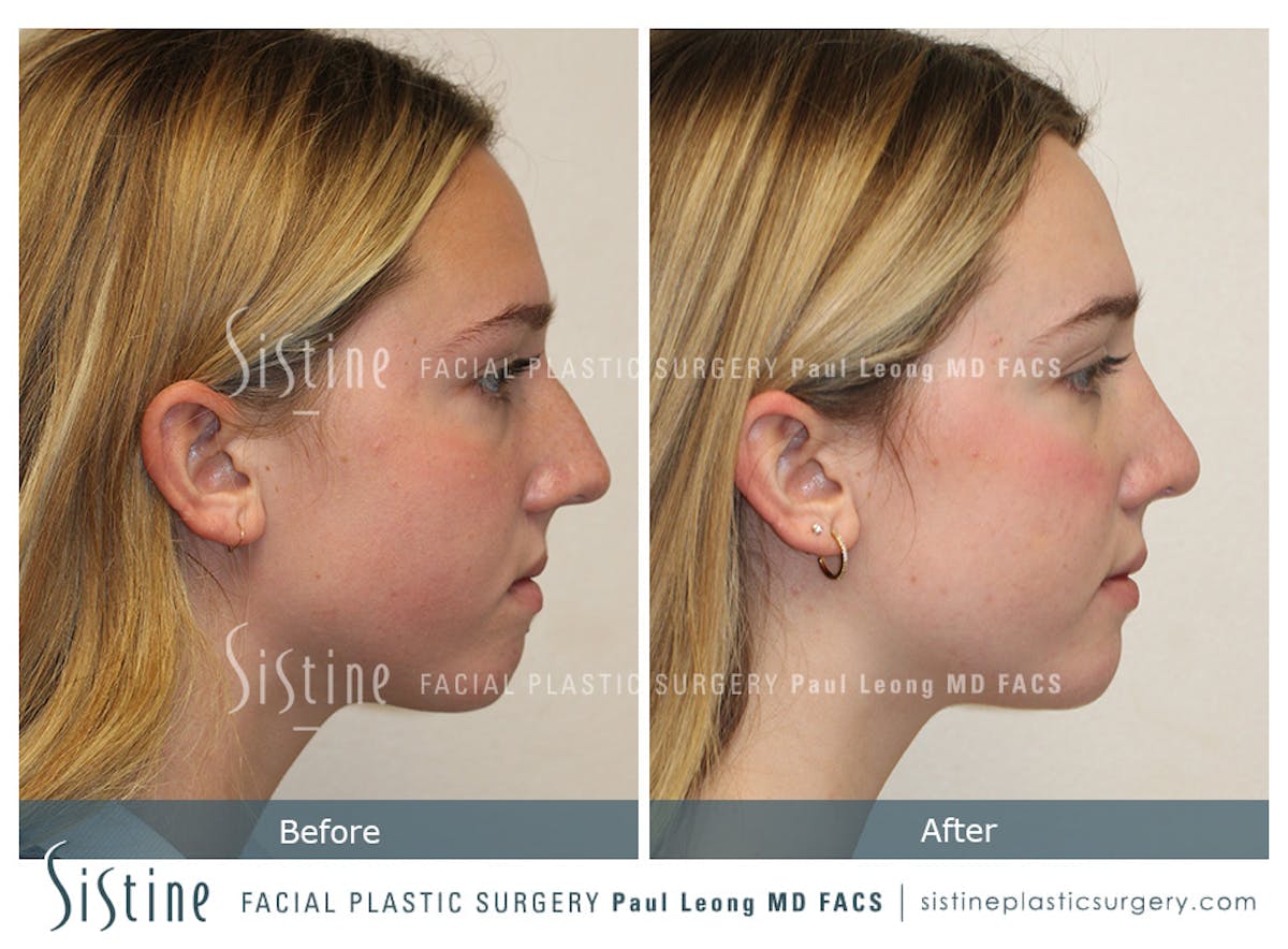 Rhinoplasty Before & After Gallery - Patient 190914 - Image 5