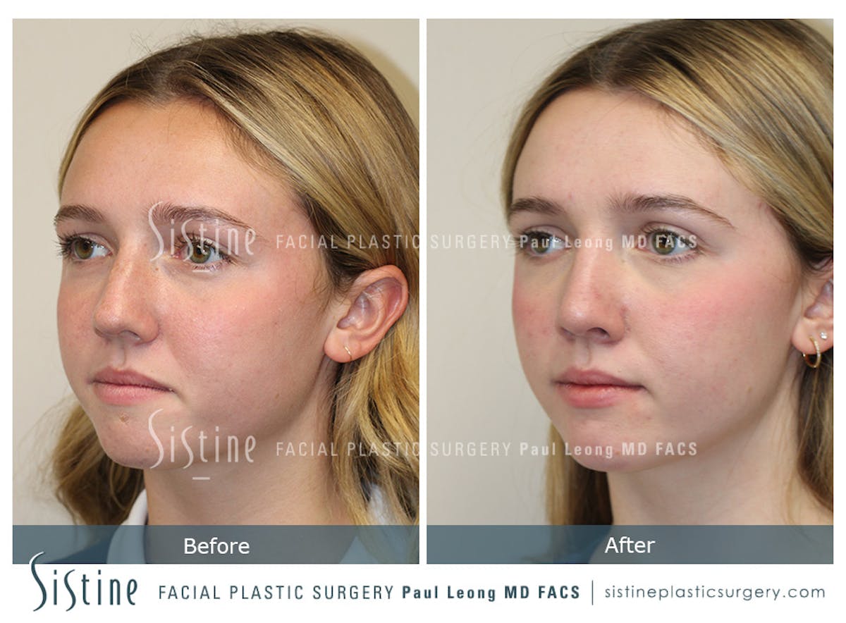 Rhinoplasty Before & After Gallery - Patient 190914 - Image 6