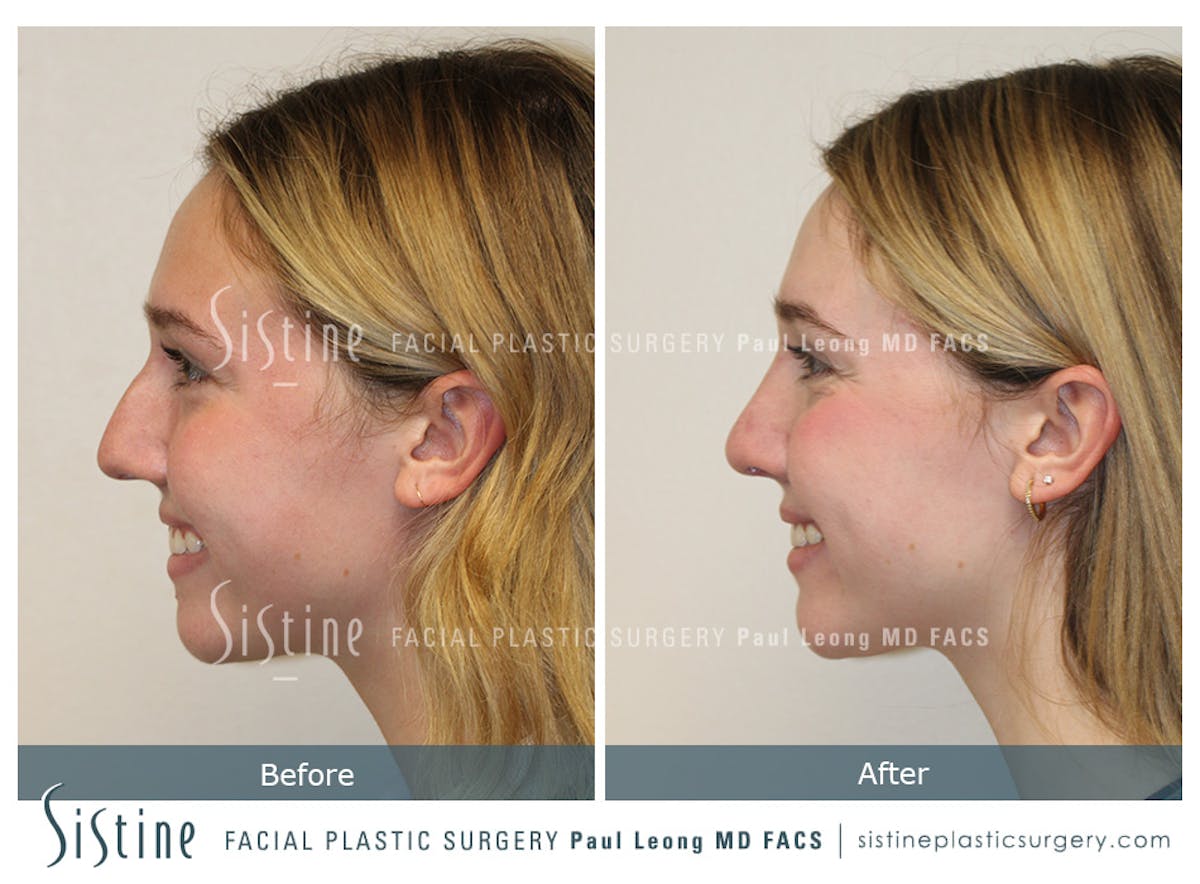 Rhinoplasty Before & After Gallery - Patient 190914 - Image 7