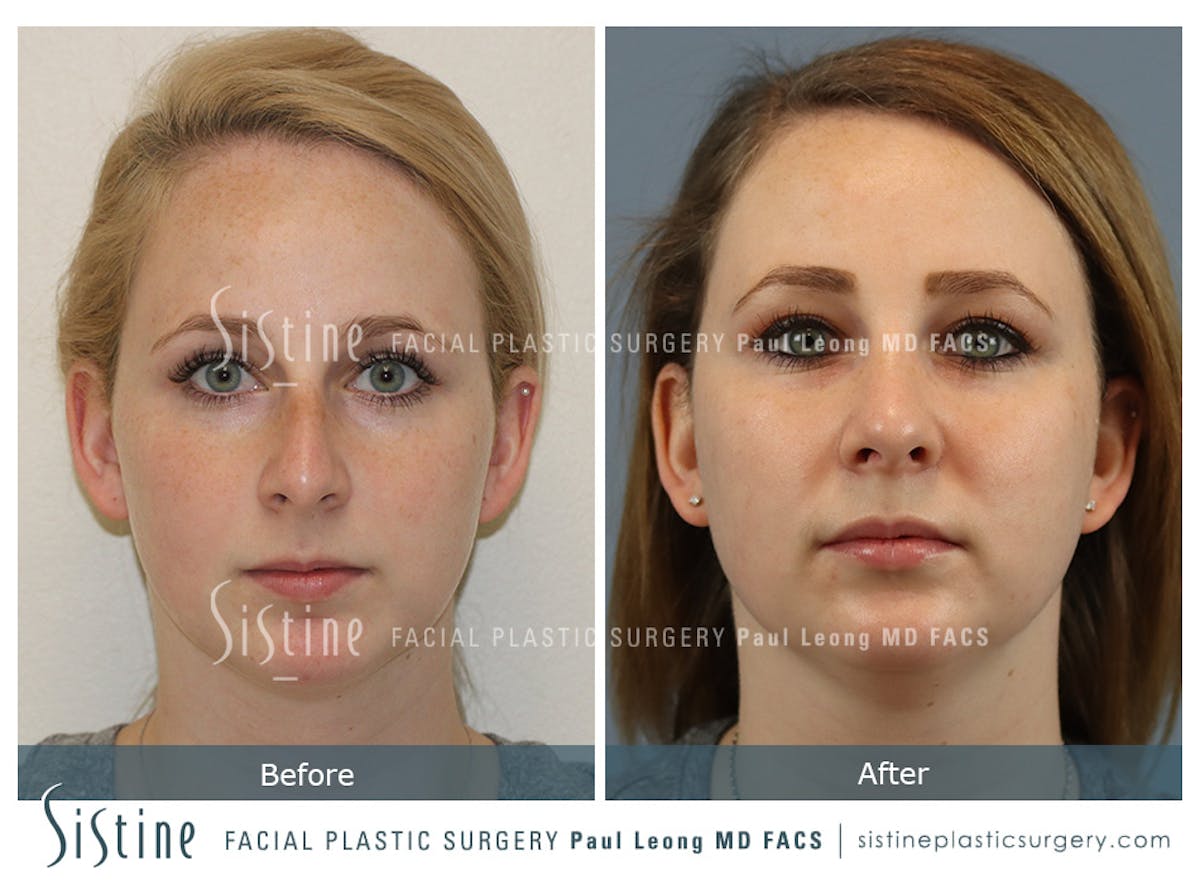 Rhinoplasty Before & After Gallery - Patient 341647 - Image 1