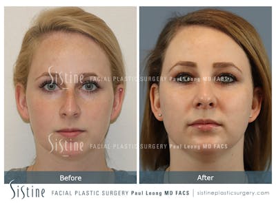 Rhinoplasty Before & After Gallery - Patient 341647 - Image 1