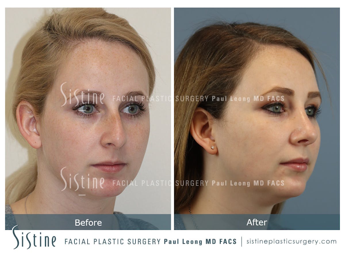 Rhinoplasty Before & After Gallery - Patient 341647 - Image 2