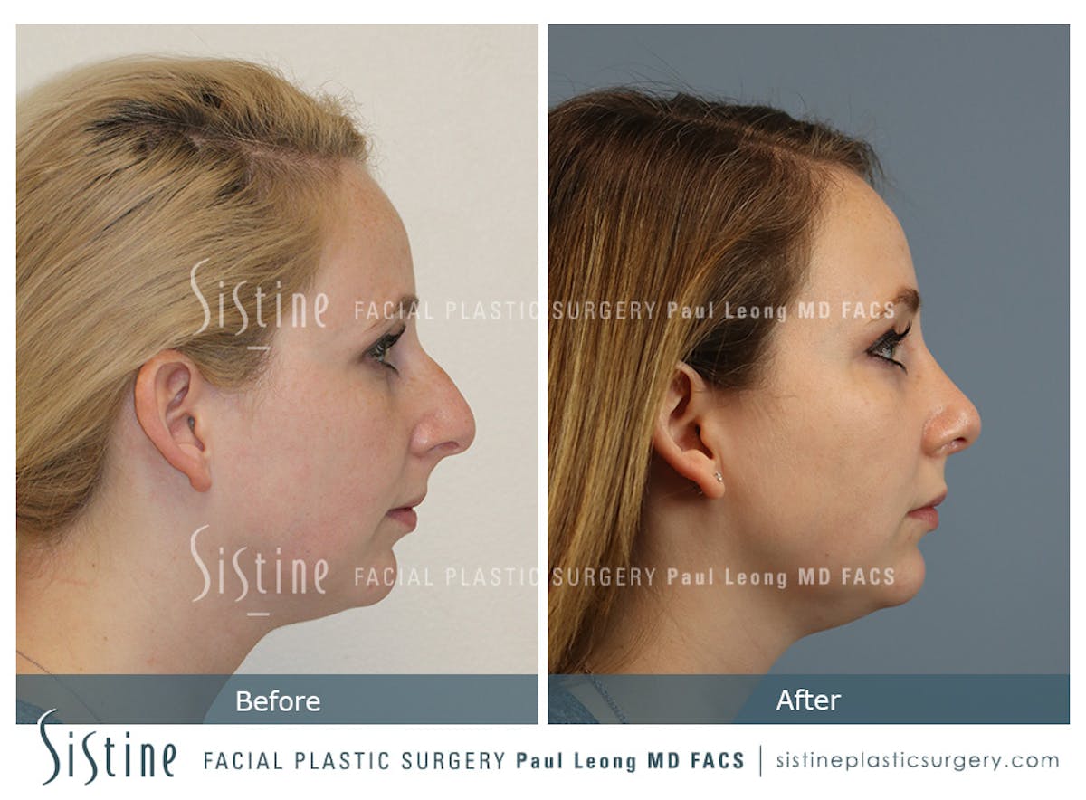 Rhinoplasty Before & After Gallery - Patient 341647 - Image 3