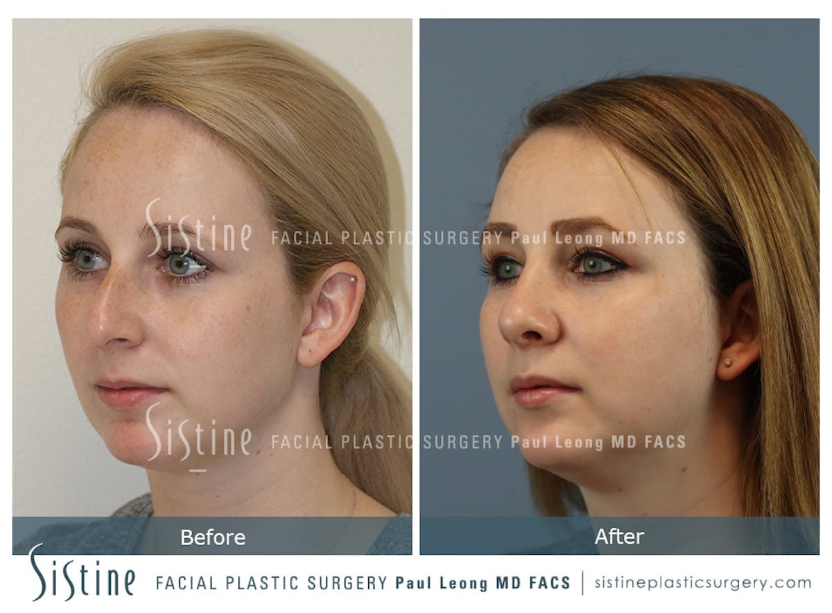 Rhinoplasty Before & After Gallery - Patient 341647 - Image 4