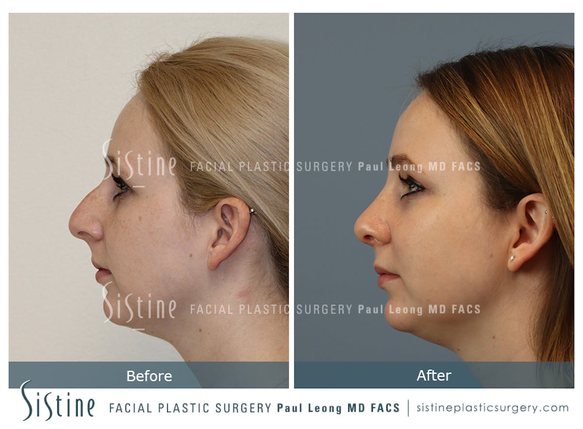 Rhinoplasty Before & After Gallery - Patient 341647 - Image 5
