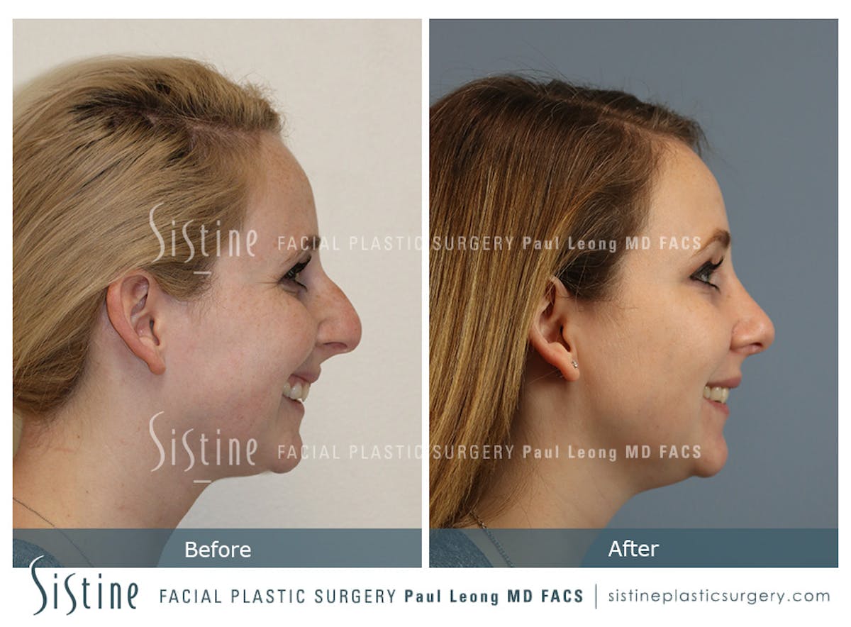 Rhinoplasty Before & After Gallery - Patient 341647 - Image 6