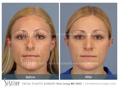 Rhinoplasty Before & After Gallery - Patient 364985 - Image 1