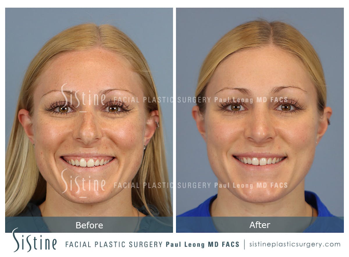 Rhinoplasty Before & After Gallery - Patient 364985 - Image 2