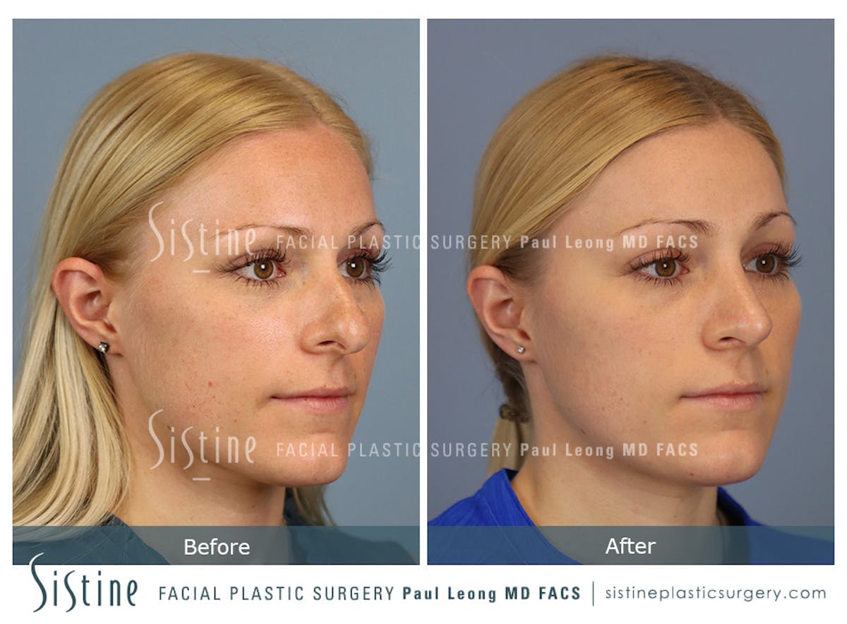 Rhinoplasty Before & After Gallery - Patient 364985 - Image 3