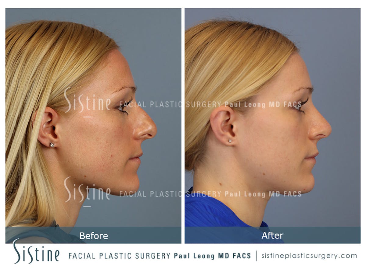 Rhinoplasty Before & After Gallery - Patient 364985 - Image 4