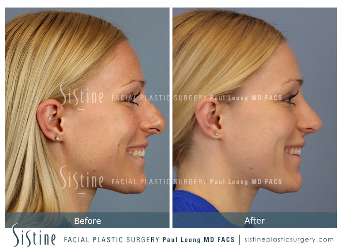 Rhinoplasty Before & After Gallery - Patient 364985 - Image 5