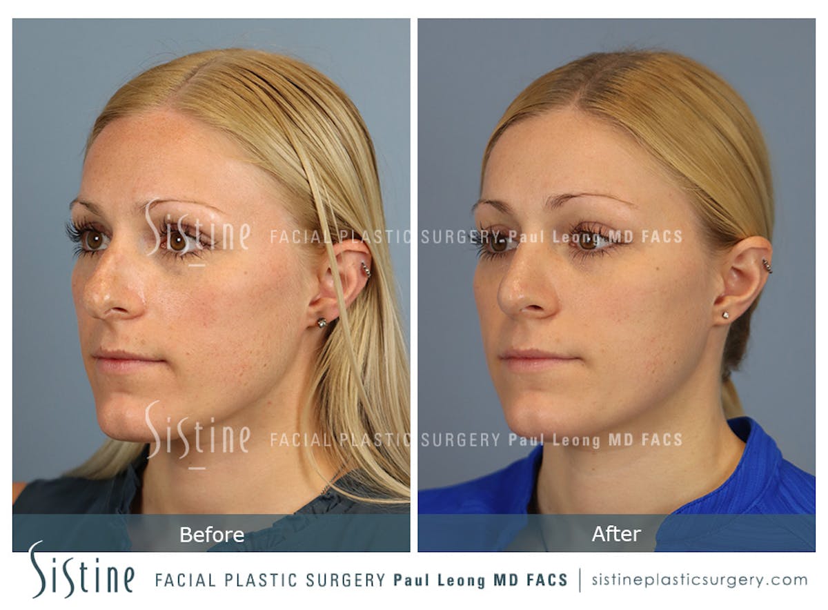 Rhinoplasty Before & After Gallery - Patient 364985 - Image 6