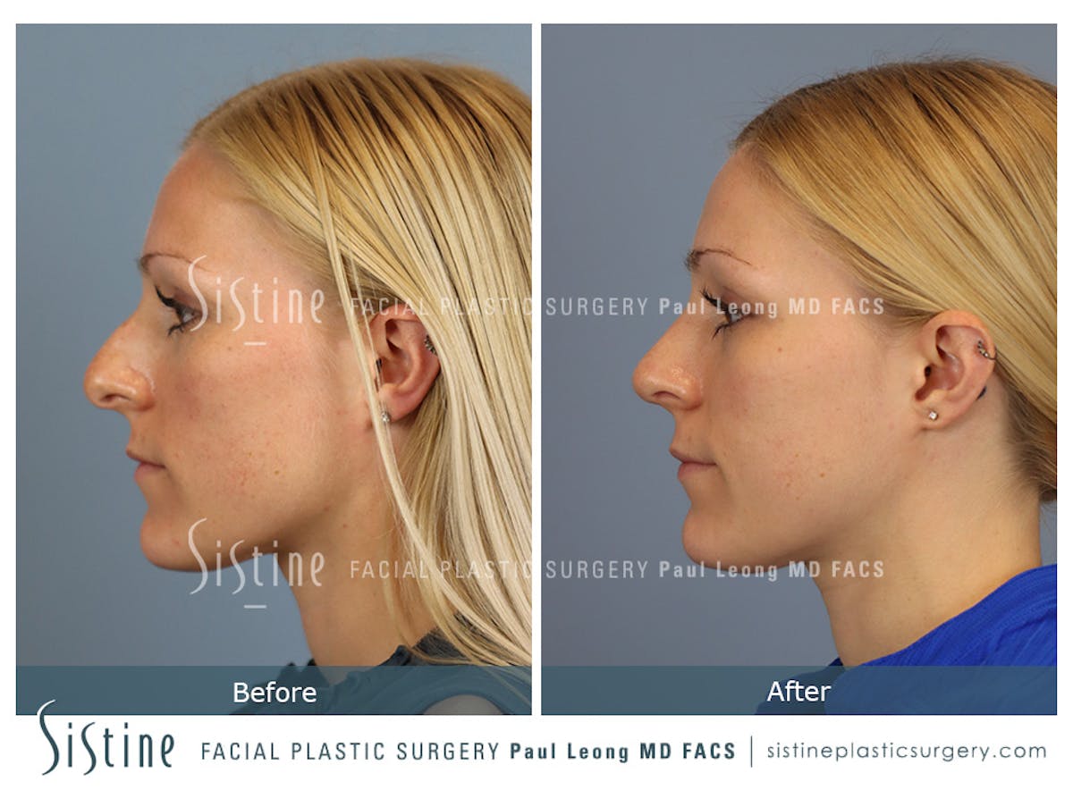 Rhinoplasty Before & After Gallery - Patient 364985 - Image 7