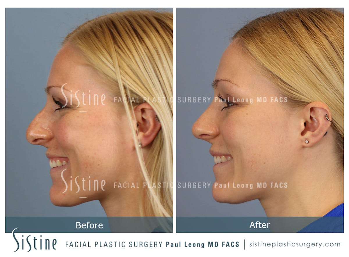 Rhinoplasty Before & After Gallery - Patient 364985 - Image 8
