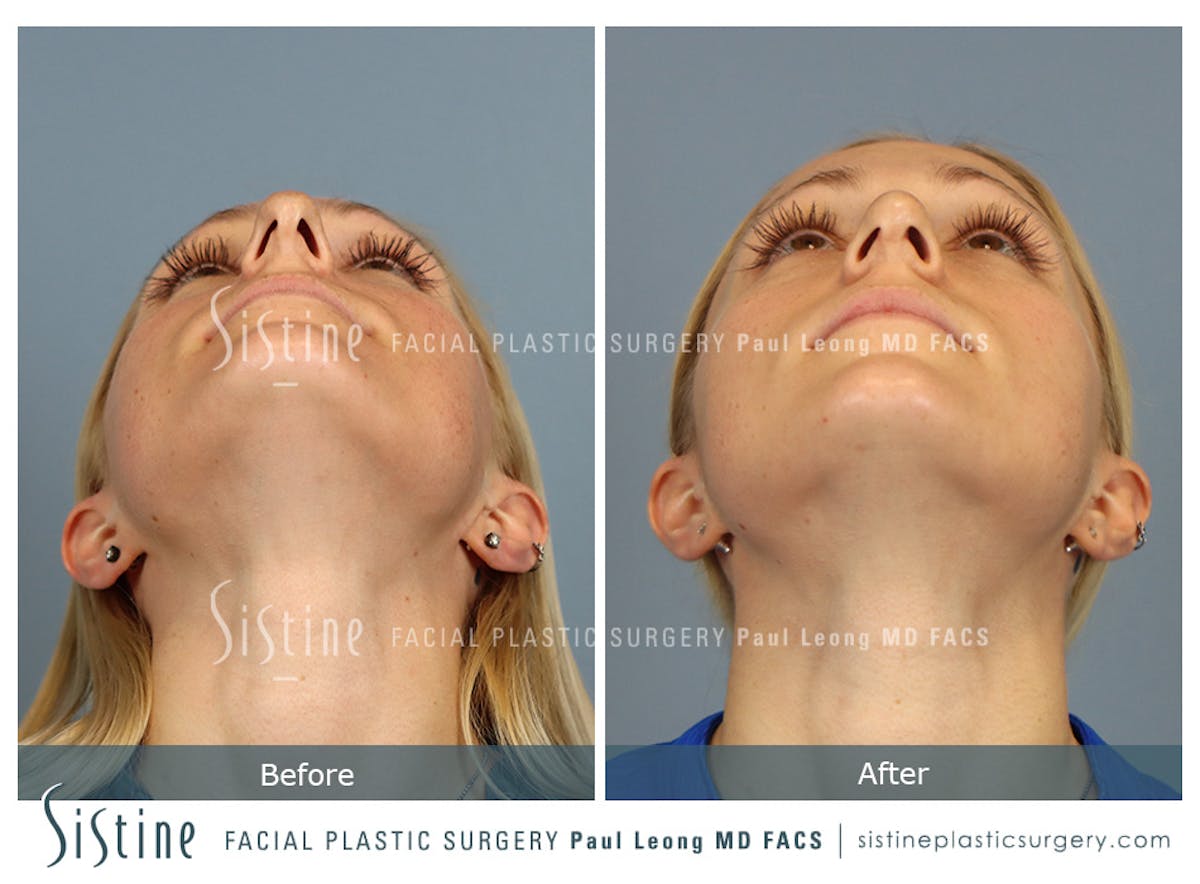 Rhinoplasty Before & After Gallery - Patient 364985 - Image 9
