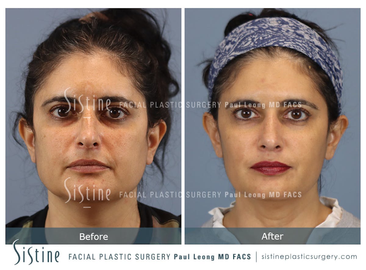 Rhinoplasty Before & After Gallery - Patient 284649 - Image 1