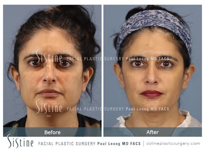 Rhinoplasty Before & After Gallery - Patient 284649 - Image 1