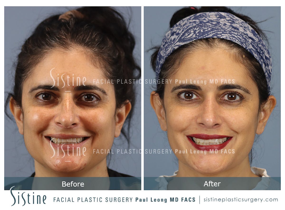 Rhinoplasty Before & After Gallery - Patient 284649 - Image 2