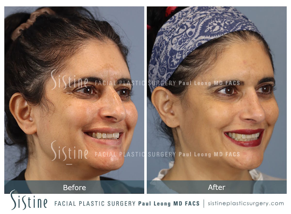 Rhinoplasty Before & After Gallery - Patient 284649 - Image 4