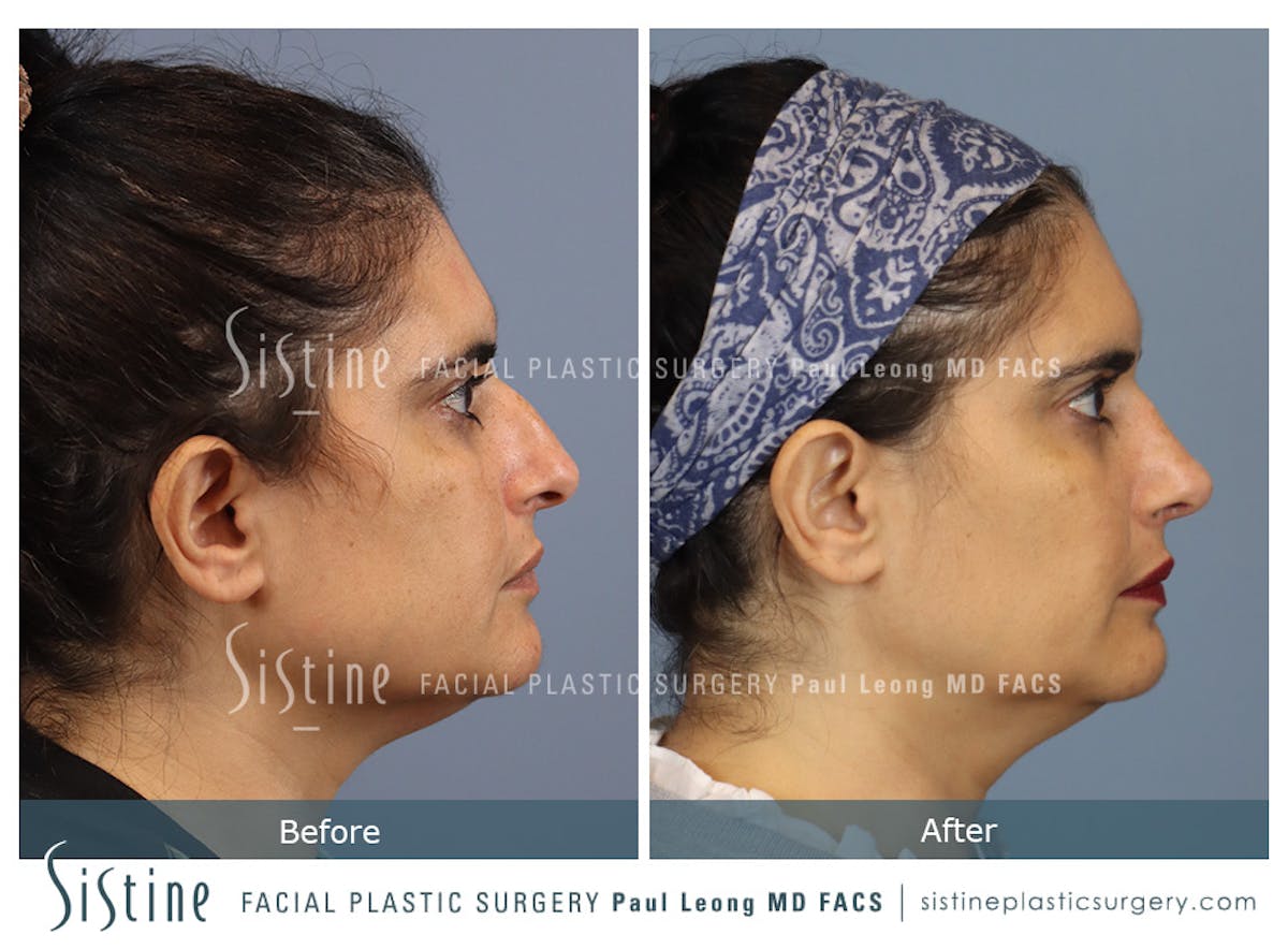 Rhinoplasty Before & After Gallery - Patient 284649 - Image 5