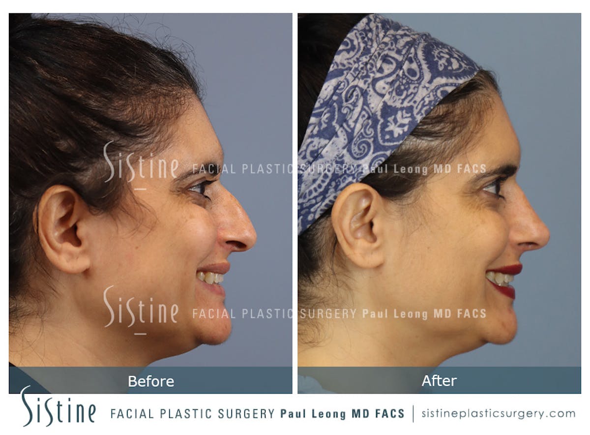 Rhinoplasty Before & After Gallery - Patient 284649 - Image 6