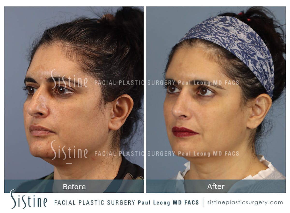 Rhinoplasty Before & After Gallery - Patient 284649 - Image 7
