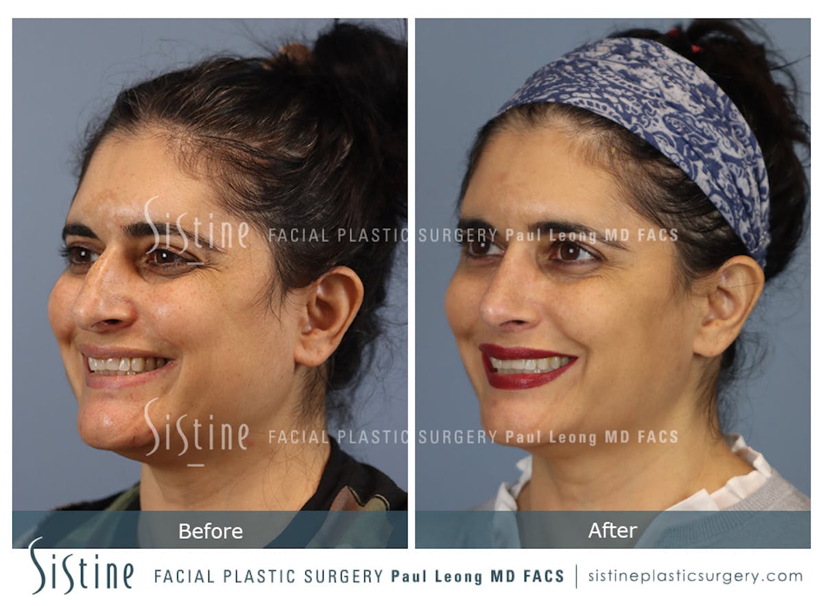Rhinoplasty Before & After Gallery - Patient 284649 - Image 8