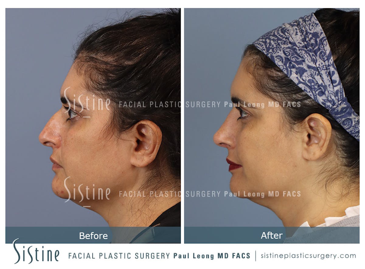 Rhinoplasty Before & After Gallery - Patient 284649 - Image 9