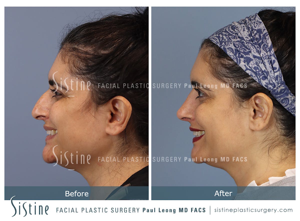 Rhinoplasty Before & After Gallery - Patient 284649 - Image 10