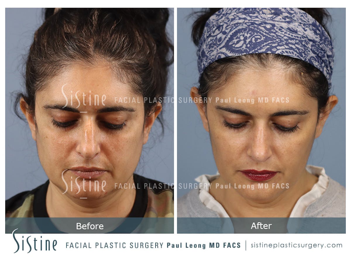 Rhinoplasty Before & After Gallery - Patient 284649 - Image 11