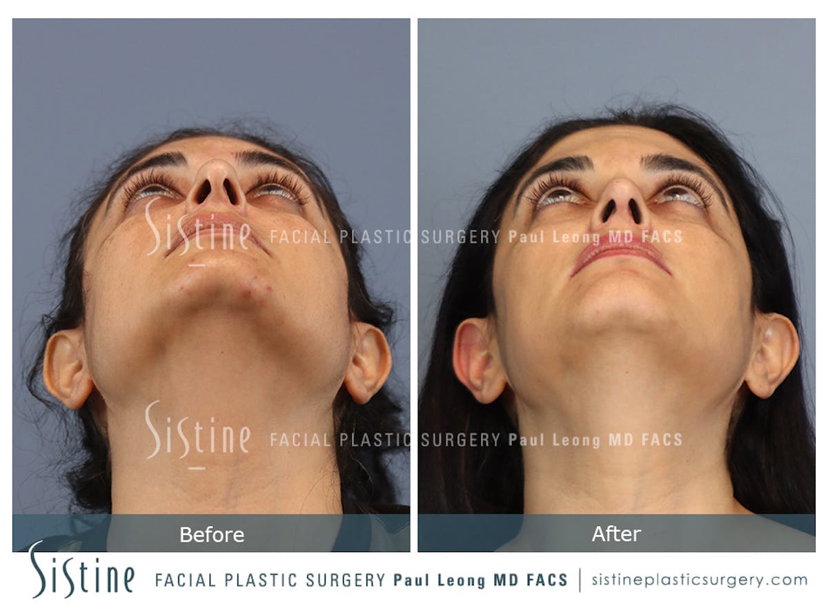 Rhinoplasty Before & After Gallery - Patient 284649 - Image 12