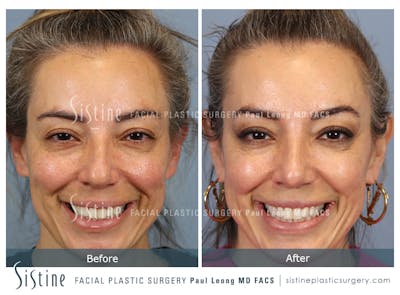 Rhinoplasty Before & After Gallery - Patient 241254 - Image 1