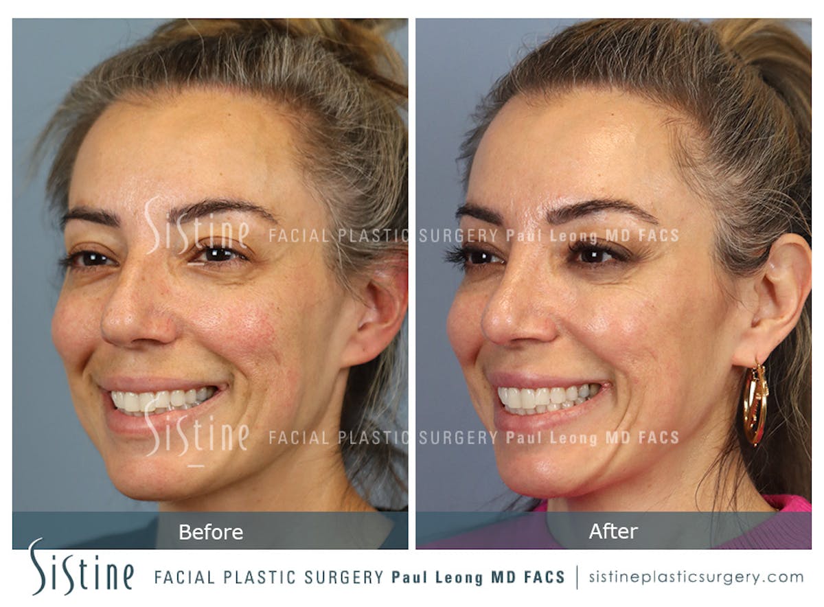 Rhinoplasty Before & After Gallery - Patient 241254 - Image 2