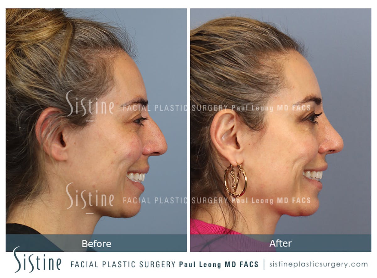 Rhinoplasty Before & After Gallery - Patient 241254 - Image 3