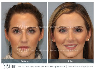 Rhinoplasty Before & After Gallery - Patient 985131 - Image 1