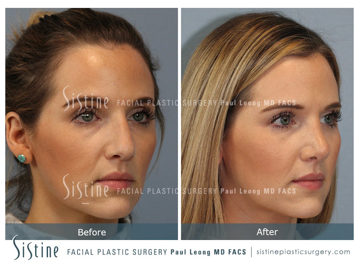 Rhinoplasty Before & After Gallery - Patient 985131 - Image 2